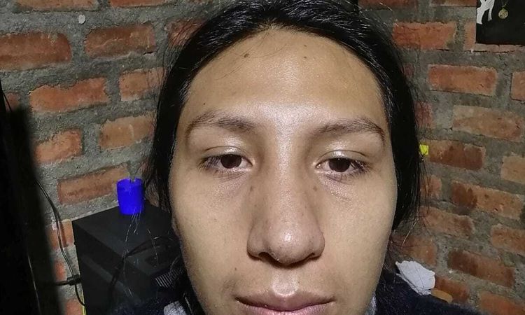 Nariz taponada y tabique desviado tras rinoplastia - 46301