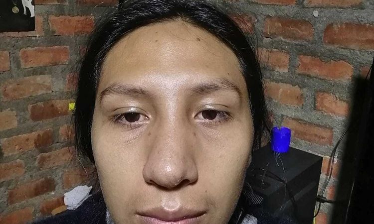 Nariz taponada y tabique desviado tras rinoplastia - 46302