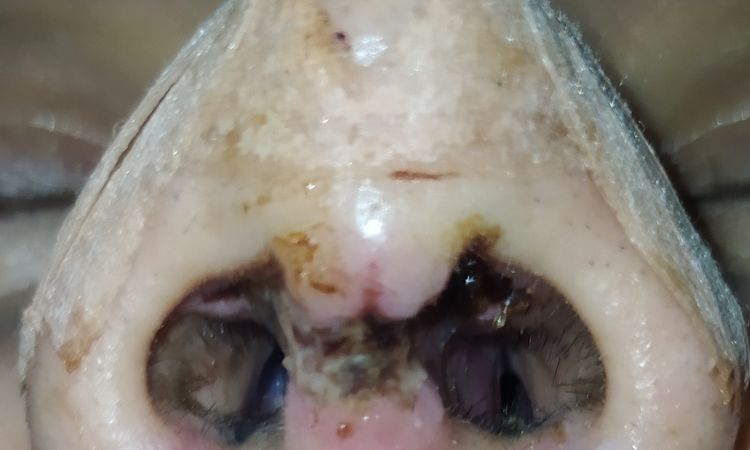 Mala cicatrización columela tras rinoplastia abierta - 46436