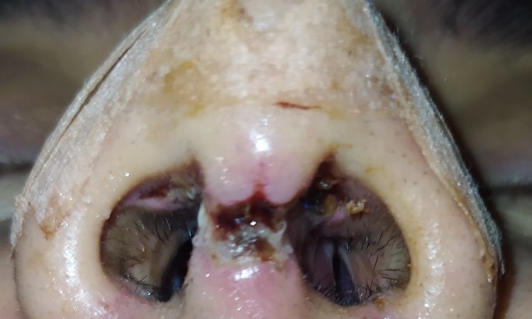 Mala cicatrización columela tras rinoplastia abierta - 46437