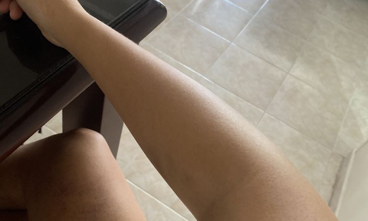 Brazo con dolor tras lipoescultura - 46944