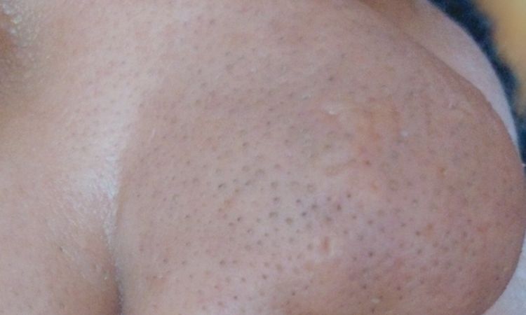 Rinoplastia en piel gruesa - 46987