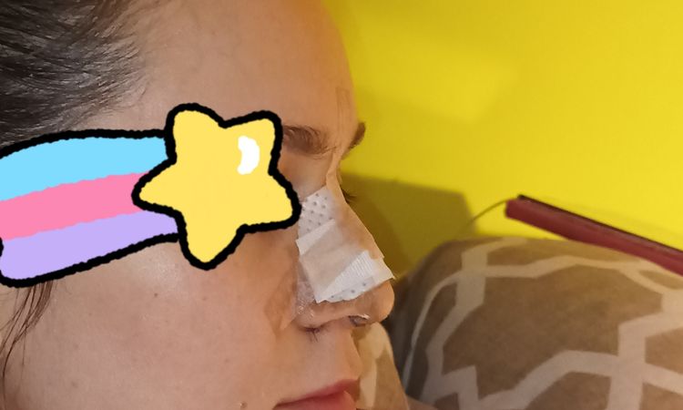 Punta nariz baja después de mi rinoplastia - 47374