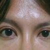 Asimetría ocular tras blefaroplastia