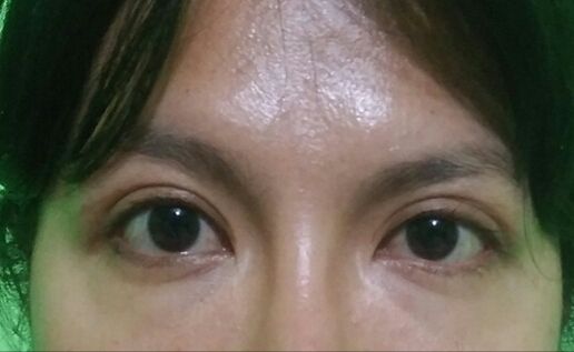 Asimetría ocular tras blefaroplastia - 47608