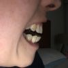 Cómo corregir ortodoncia después de 3 años