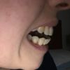 Cómo corregir ortodoncia después de 3 años
