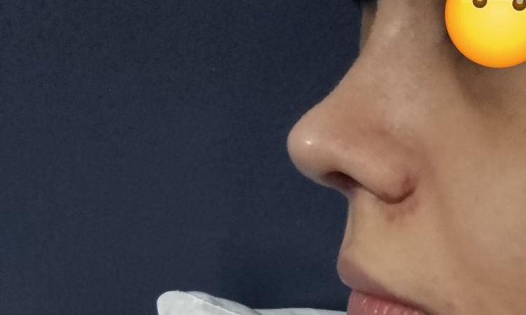 Nariz chueca post rinoplastia. He de esperar un año a corregirla? - 47971