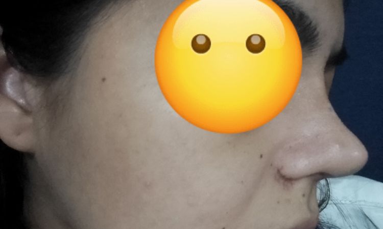 Nariz chueca post rinoplastia. He de esperar un año a corregirla? - 47973