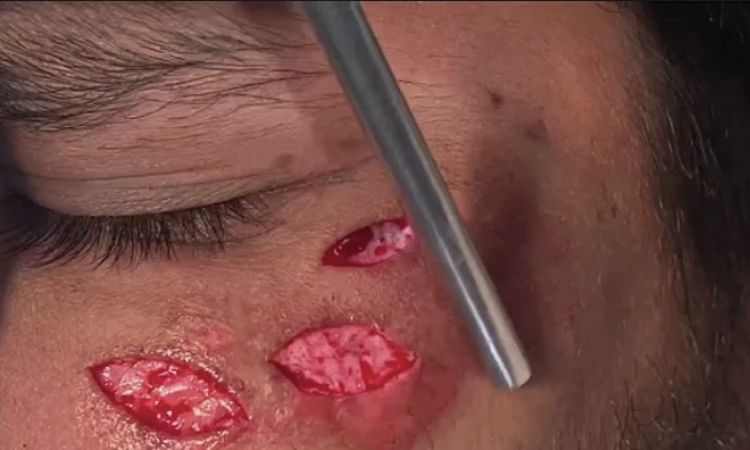 Cirugía técnica de excusión para cicatrices faciales - 48089