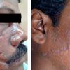 Cirugía técnica de excusión para cicatrices faciales - 48090