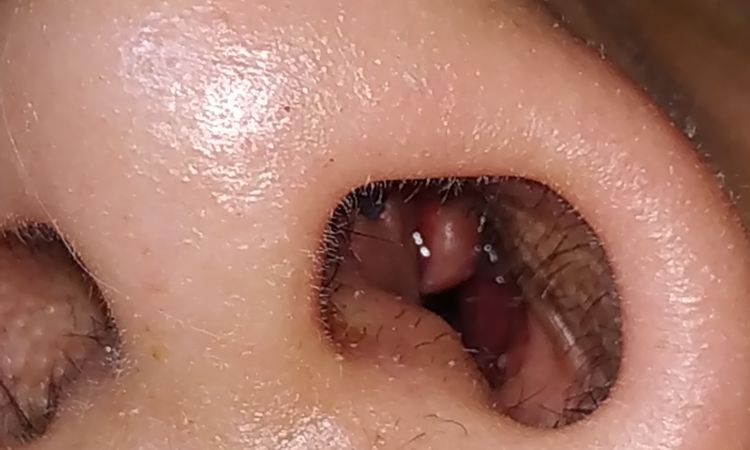 Bolita dentro de la nariz después de rinoplastia - 48384