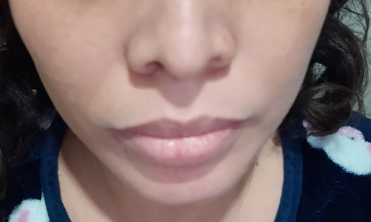 He de hacerme una rinoplastia secundaria? - 48387