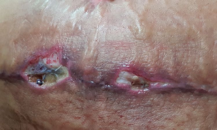 Posible infección ombligo después de abdominoplastia - 48419