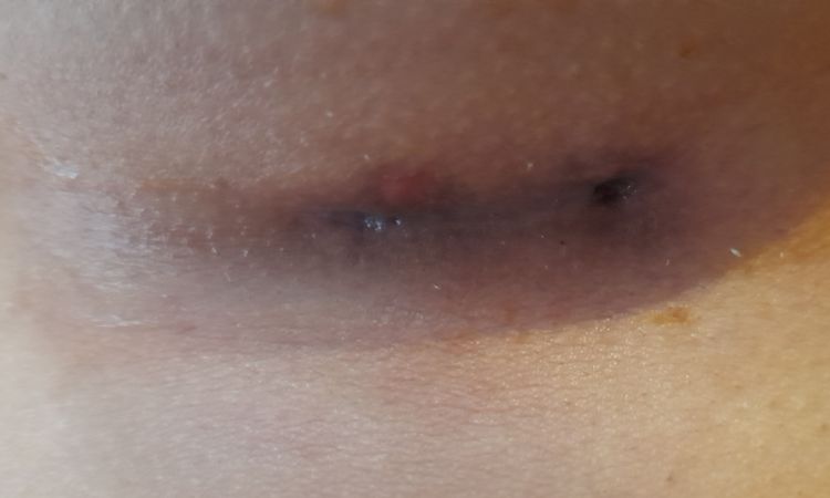 Mis cicatrices de mamoplastia de aumento no curan y se ven oscuras - 48459