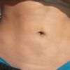 Fibrosis después de lipoescultura, responsabilidad del cirujano? Y soluciones?