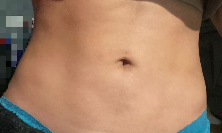 Fibrosis después de lipoescultura, responsabilidad del cirujano? Y soluciones? - 49150