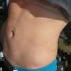Fibrosis después de lipoescultura, responsabilidad del cirujano? Y soluciones?