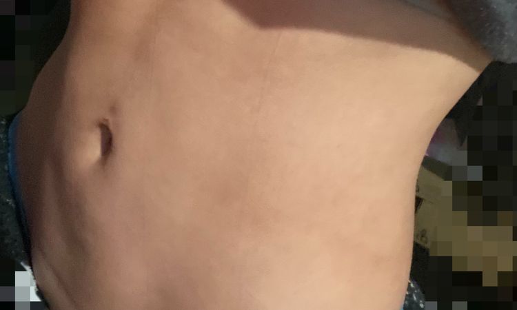Fibrosis después de lipoescultura, responsabilidad del cirujano? Y soluciones? - 49151