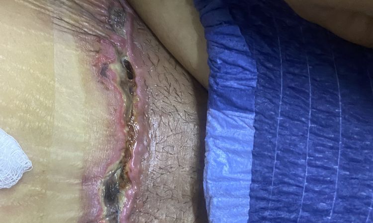 Hoyo en cicatriz de abdominoplastia - 49199