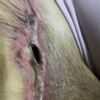 Hoyo en cicatriz de abdominoplastia