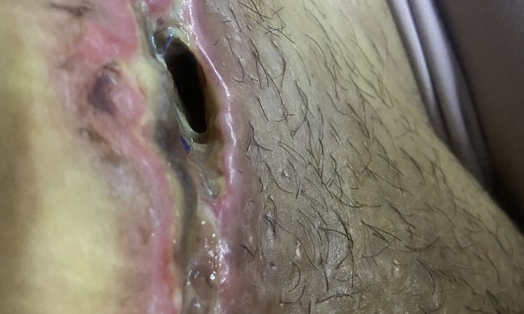 Hoyo en cicatriz de abdominoplastia - 49200