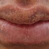 Tratamiento para fordyce en labios