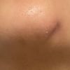 Hundimiento en mentoplastia