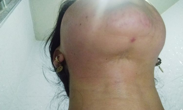 Bultos dolorosos bajo el mentón después de lipopapada - 50456