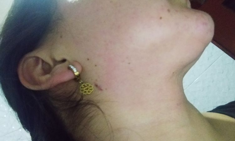 Bultos dolorosos bajo el mentón después de lipopapada - 50457