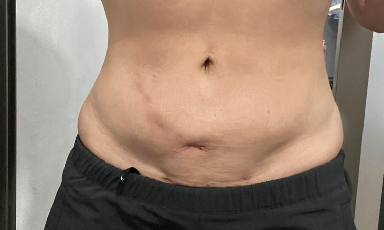 Abdomen bajo sigue inflamado después 6 meses lipoescultura 360 - 50472