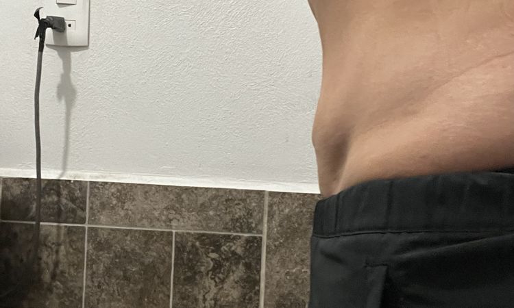 Abdomen bajo sigue inflamado después 6 meses lipoescultura 360 - 50473