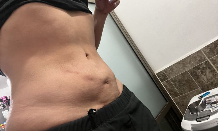 Abdomen bajo sigue inflamado después 6 meses lipoescultura 360 - 50474