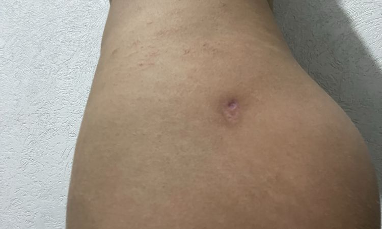 Cómo disminuir o eliminar las cicatrices de las cánulas de lipoescultura? - 50782