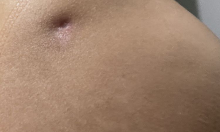 Cómo disminuir o eliminar las cicatrices de las cánulas de lipoescultura? - 50783