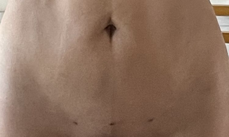 Cómo disminuir o eliminar las cicatrices de las cánulas de lipoescultura? - 50784
