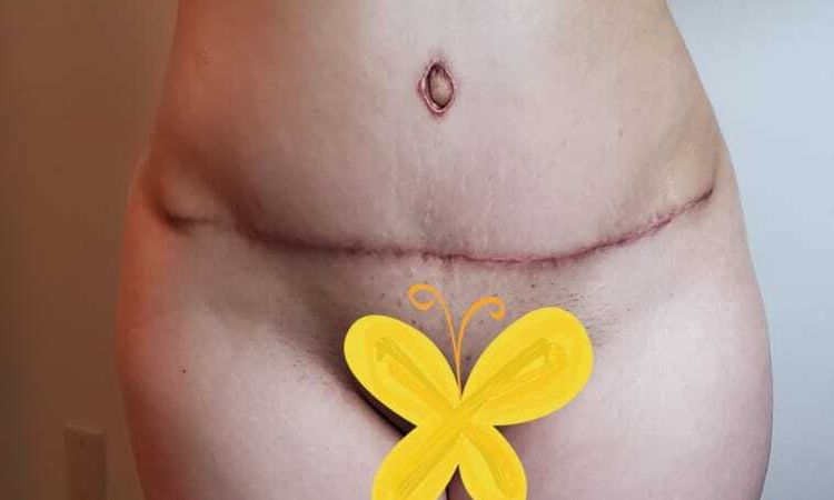 Mejorar resultados de mommy makeover post 9 meses - 51191