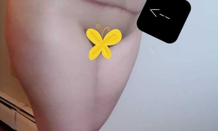 Mejorar resultados de mommy makeover post 9 meses - 51192