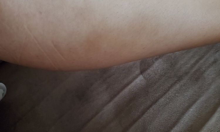 Mejorar resultados de mommy makeover post 9 meses - 51194