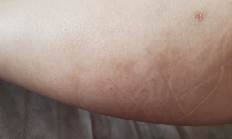 Mejorar resultados de mommy makeover post 9 meses - 51195