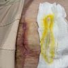 Cicatriz de abdominoplastia sigue abierta y drenando después de 4 meses