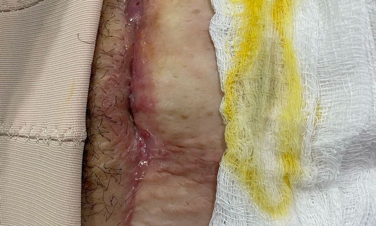 Cicatriz de abdominoplastia sigue abierta y drenando después de 4 meses - 51819