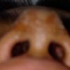 Bolitas dentro de mi nariz después de una rinoplastia - 51831