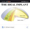 Implantes Salinos estructurados IDEAL