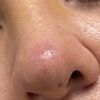 Punta de la nariz roja tras rinoplastia con cartílago para levantar punta - 52151