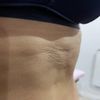 Corregir fibrosis a 5 meses de abdominoplastia con morpheus8