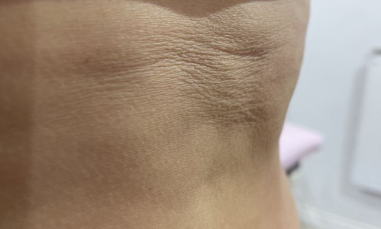 Corregir fibrosis a 5 meses de abdominoplastia con morpheus8 - 52177