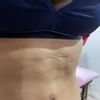 Corregir fibrosis a 5 meses de abdominoplastia con morpheus8