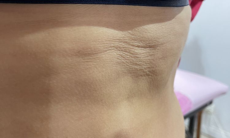 Corregir fibrosis a 5 meses de abdominoplastia con morpheus8 - 52178
