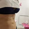 Corregir fibrosis a 5 meses de abdominoplastia con morpheus8